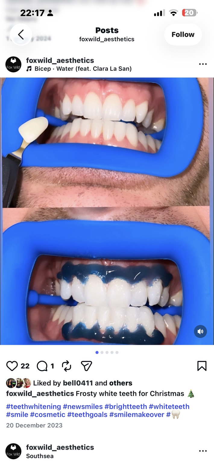 Foxwild teeth whitening comparison, third photograph, upper view