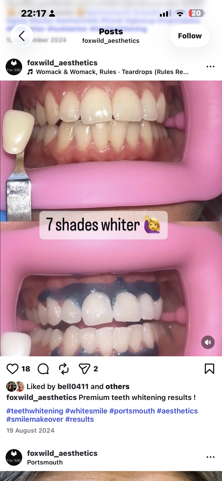 Foxwild teeth whitening before photograph, originally labelled 7 shades whiter