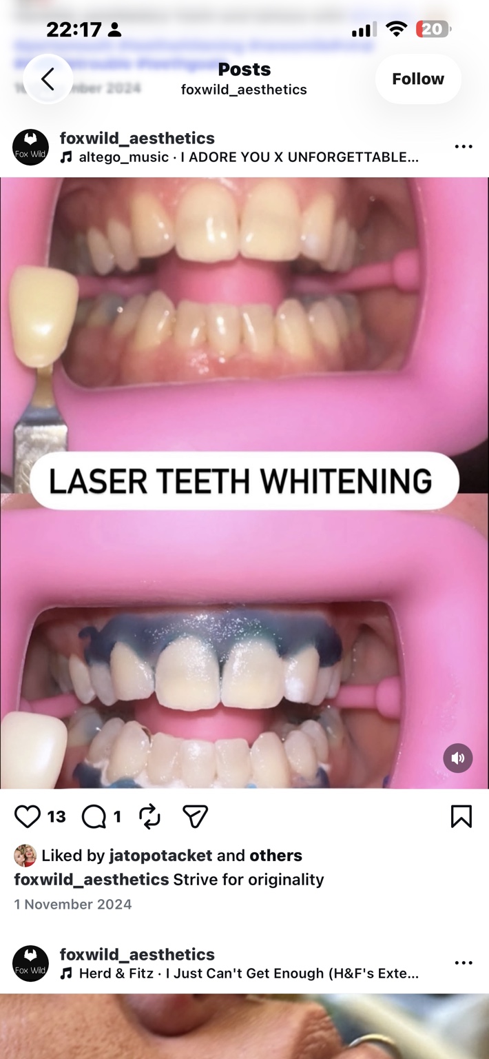 Foxwild teeth whitening comparison, second photograph, upper view